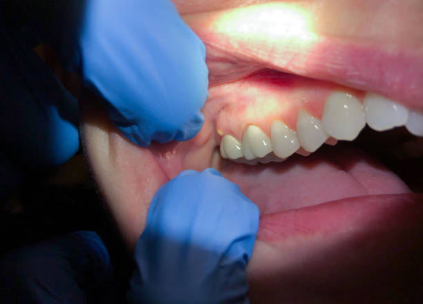 Best Emergency Treatment for Toothache in Groesbeck, TX