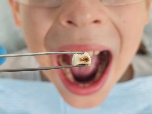 Best Emergency Treatment for Toothache in Groesbeck, TX
